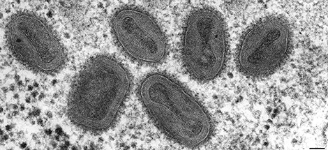 Variola major virus (Orthopockenviren), Patientenmaterial des letzten Pockenfalls in der Bundesrepublik Deutschland, Hannover 1972. Transmissions-Elektronenmikroskopie, Ultradünnschnitt. Maßstab = 200 nm. (© RKI) Variola major virus (Orthopockenviren), Patientenmaterial des letzten Pockenfalls in der Bundesrepublik Deutschland, Hannover 1972. Transmissions-Elektronenmikroskopie, Ultradünnschnitt. Maßstab = 200 nm.